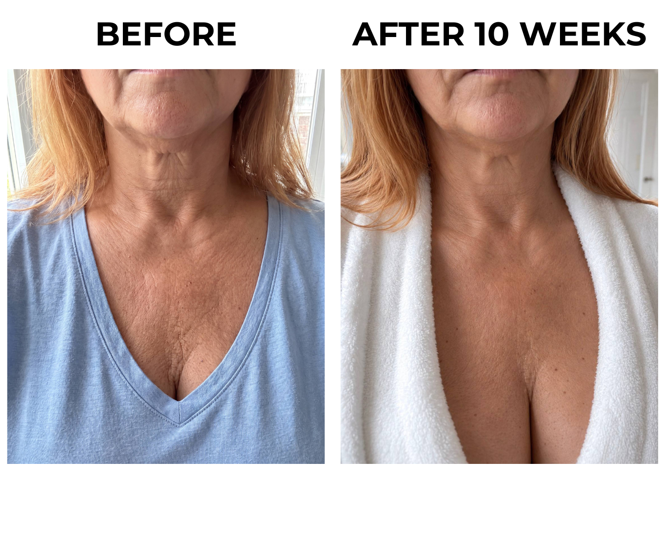 Before and after ten weeks on the neck and chest