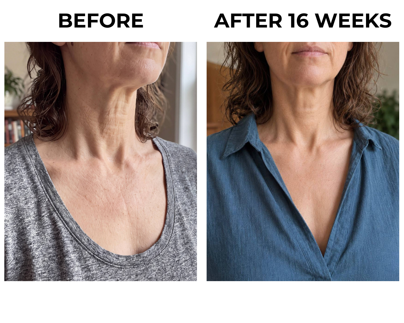 Before and after sixteen weeks on the neck and chest