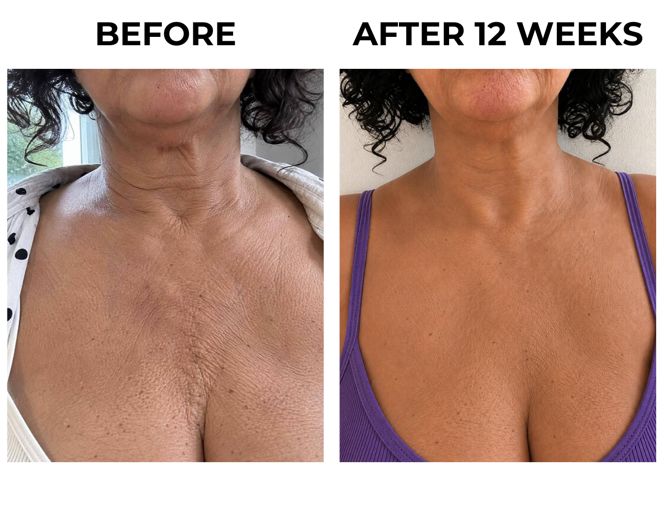 Before and after twelve weeks on the neck and chest